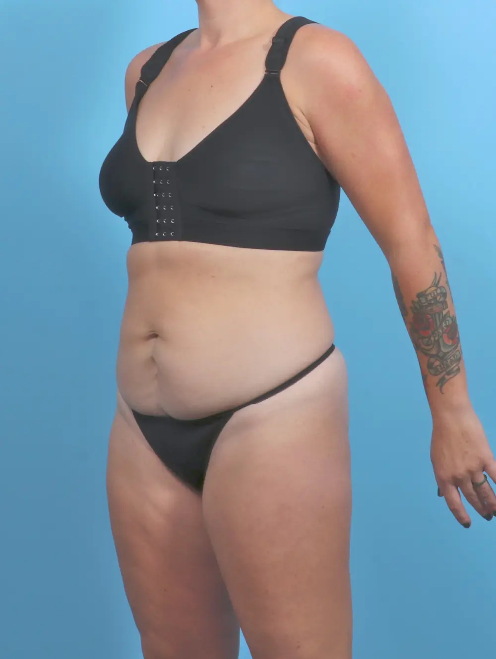 Tummy Tuck Patient Photo - Case 50812 - before view-1
