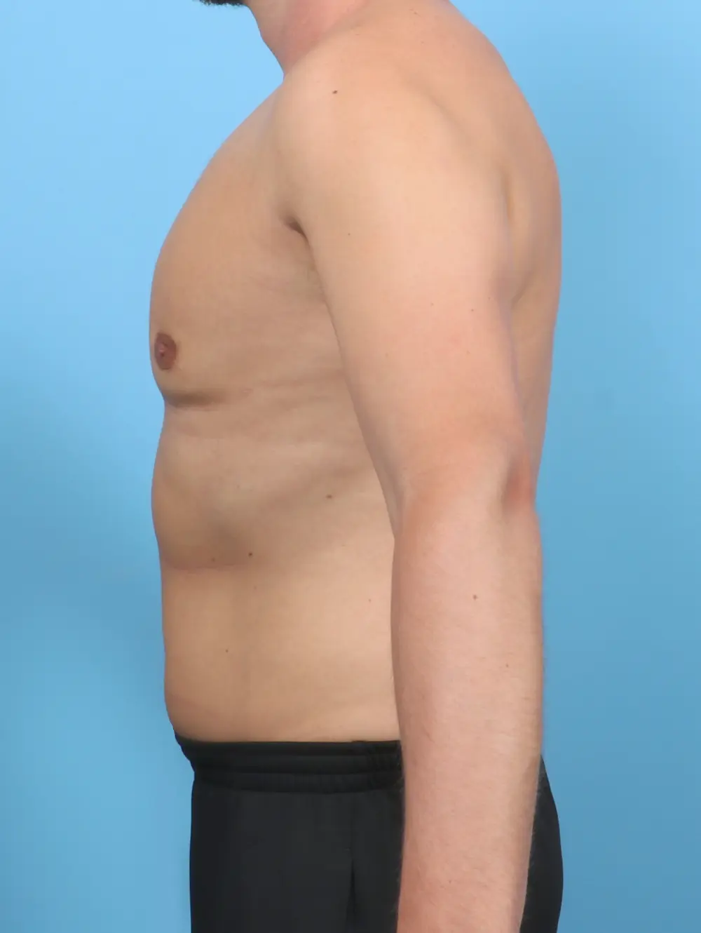 Gynecomastia Patient Photo - Case 50820 - after view-2