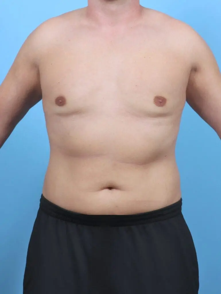 Gynecomastia - Case 50820 - After