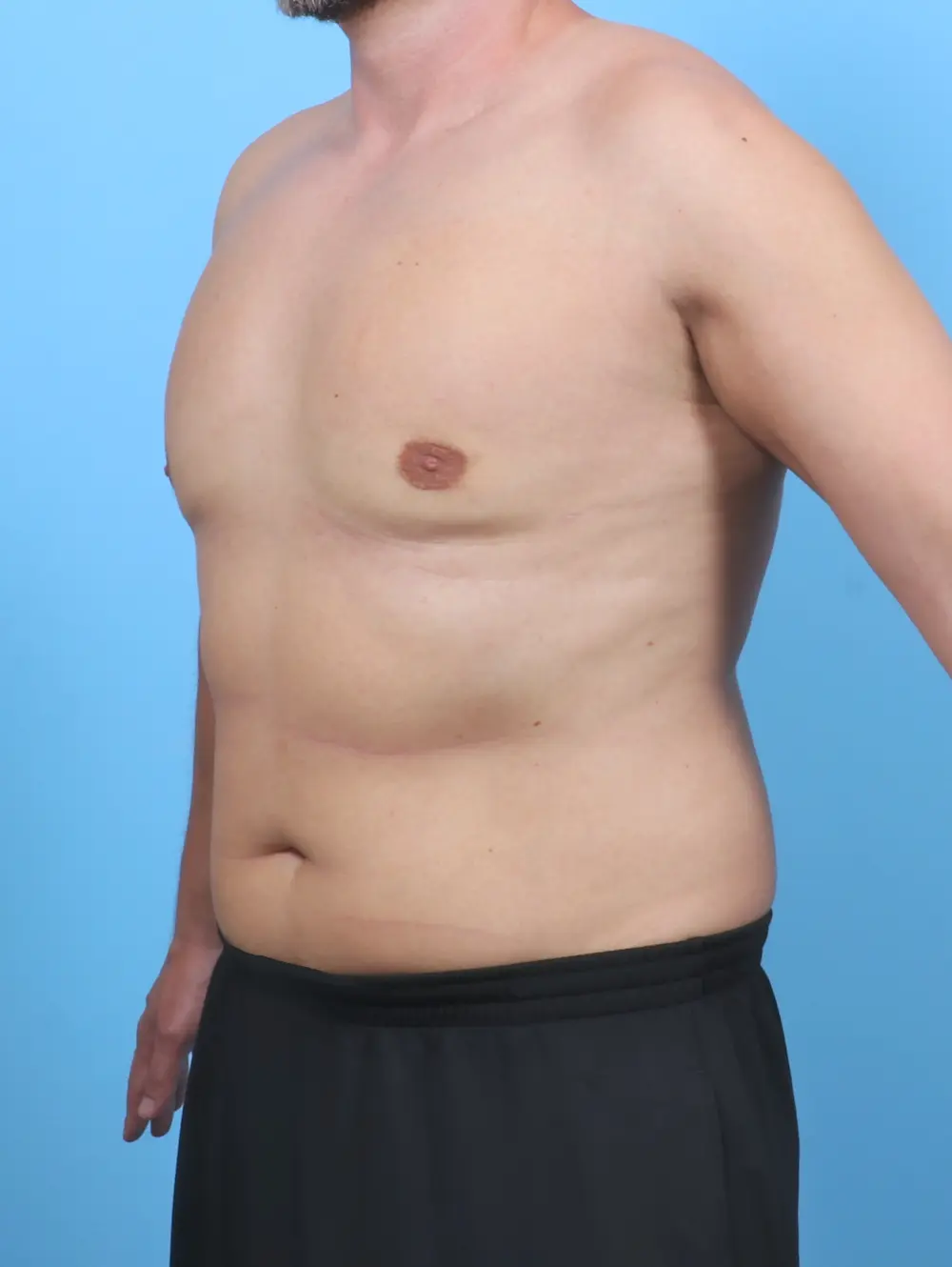 Gynecomastia Patient Photo - Case 50820 - after view-1