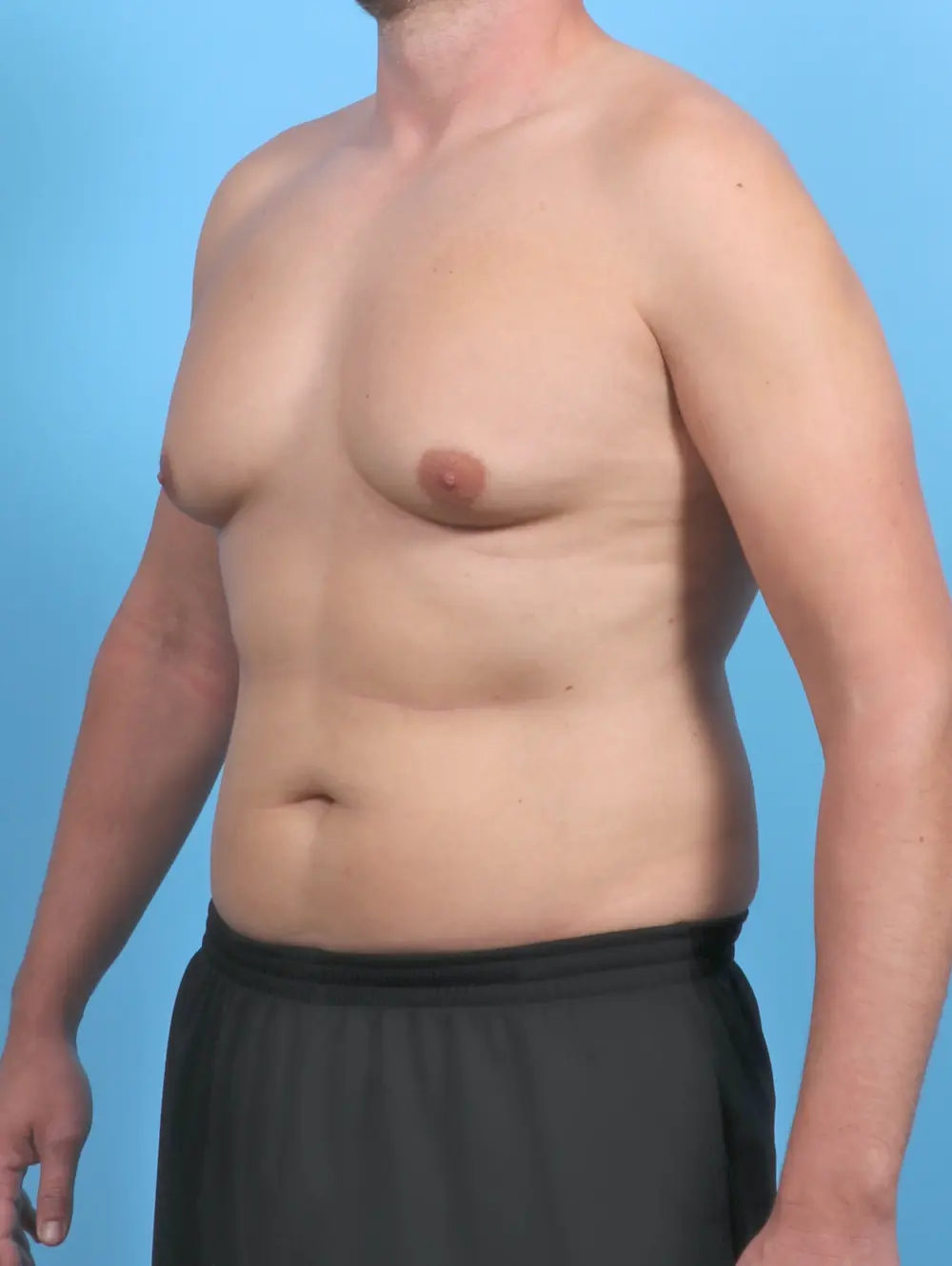 Gynecomastia Patient Photo - Case 50820 - before view-1