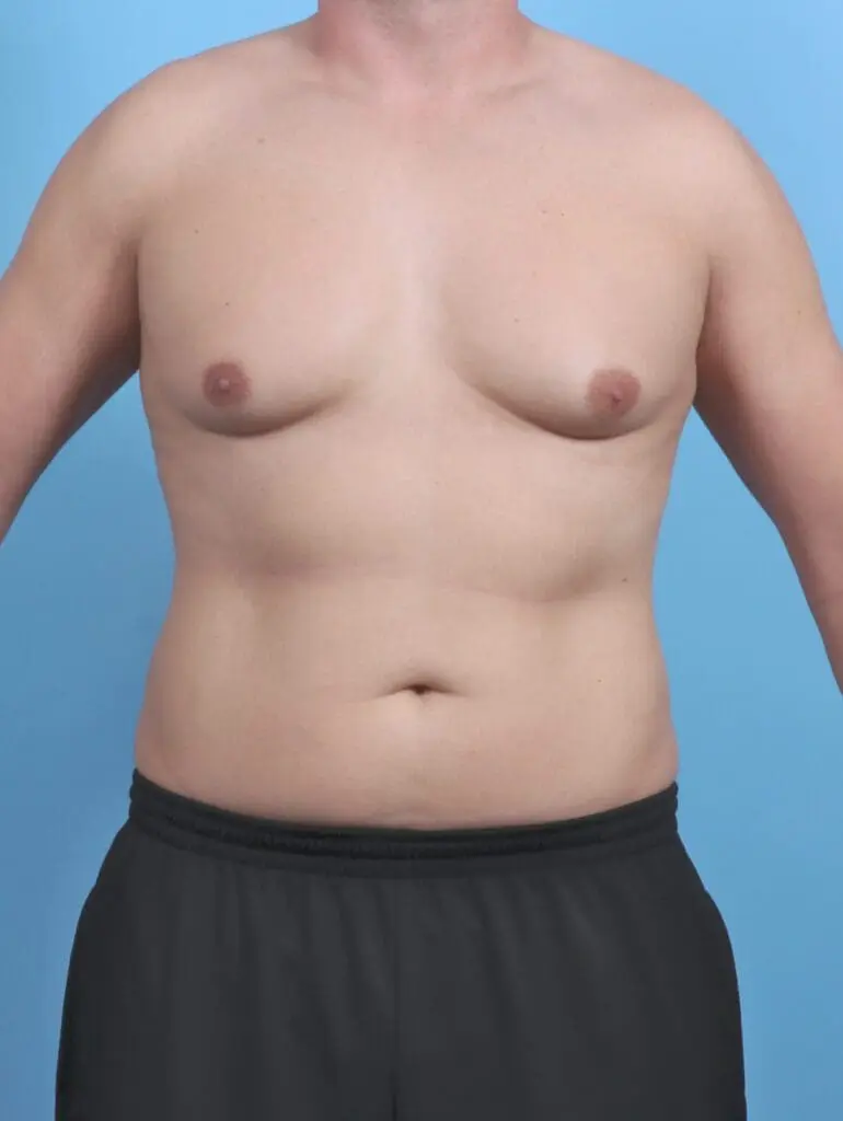 Gynecomastia - Case 50820 - Before