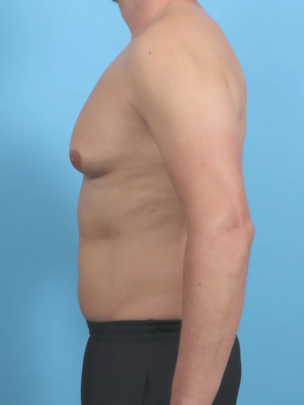 Gynecomastia Patient Photo - Case 50820 - before view-2