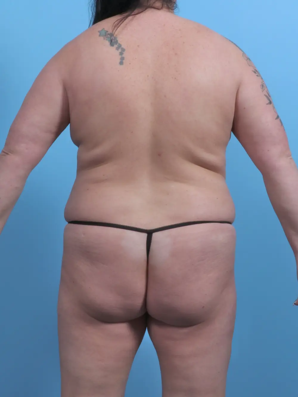 Breast Lift/Reduction with Implants Patient Photo - Case 50874 - before view-3