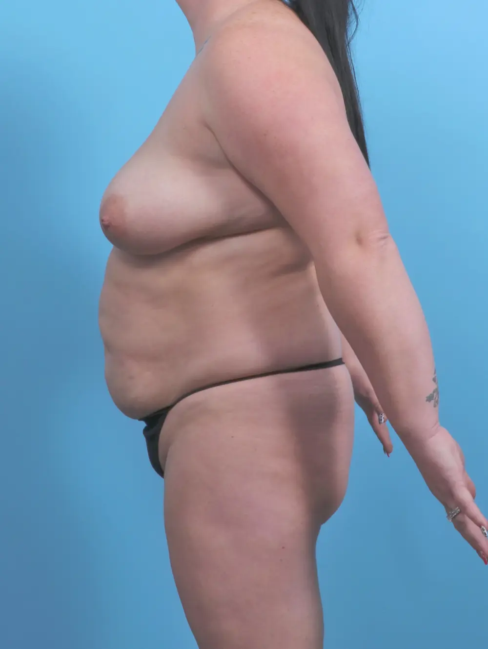 Breast Lift/Reduction with Implants Patient Photo - Case 50874 - before view-2