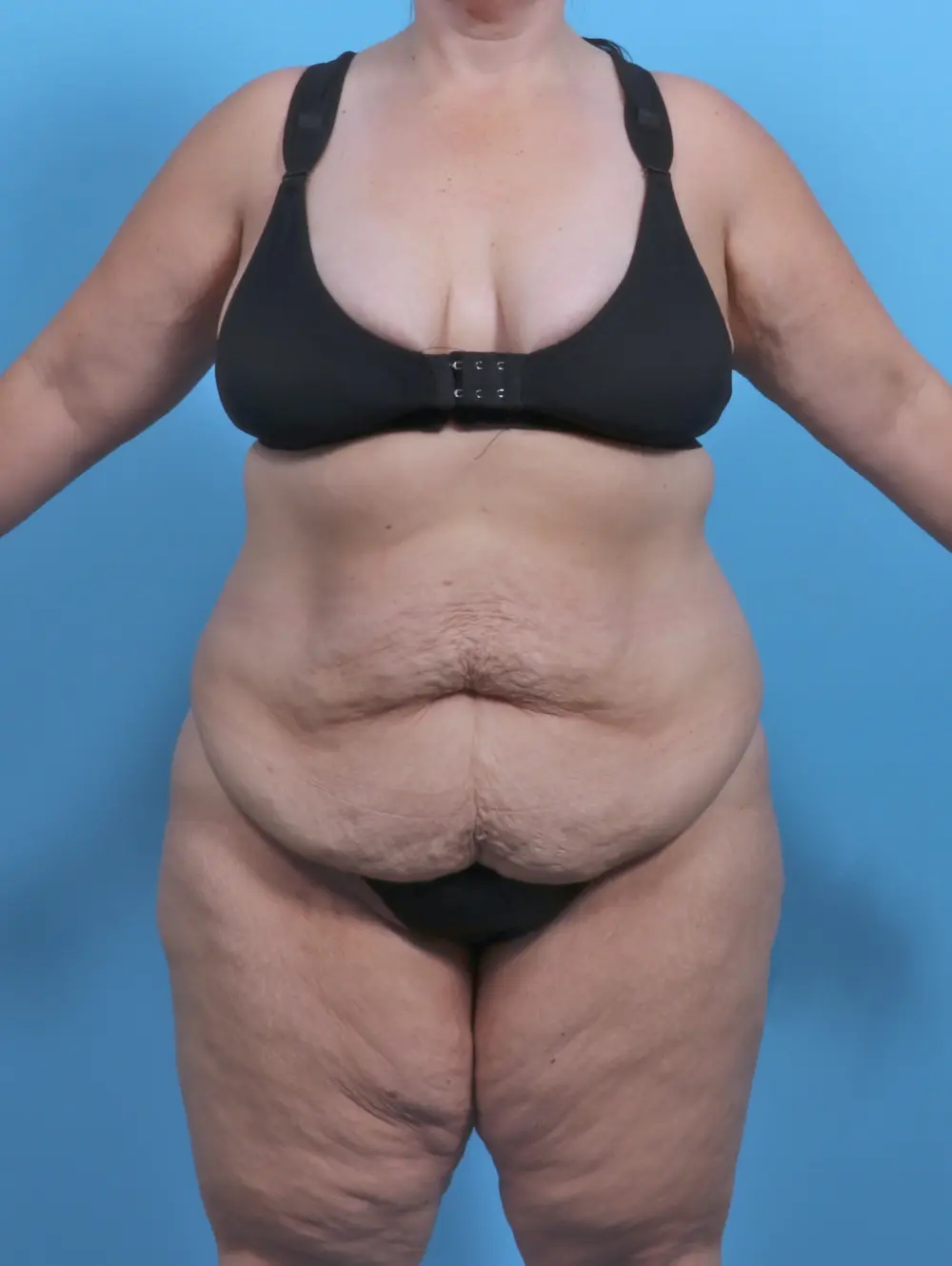 Tummy Tuck Patient Photo - Case 50884 - before view-