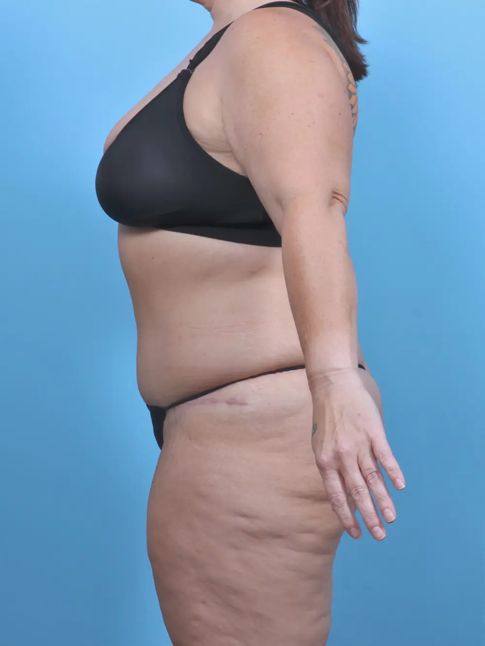 Tummy Tuck Patient Photo - Case 50884 - after view-2