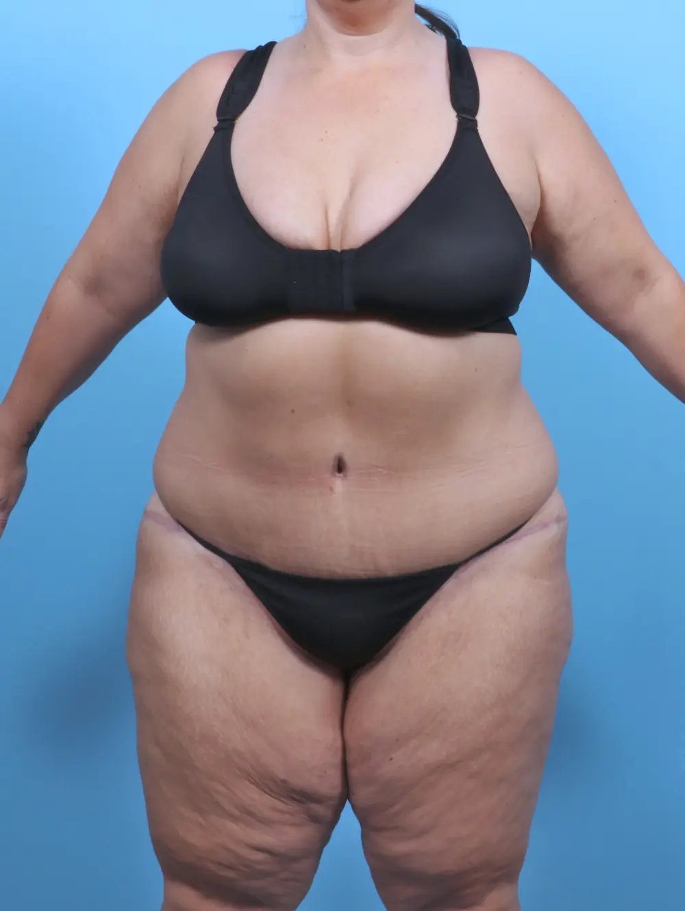 Tummy Tuck Patient Photo - Case 50884 - after view