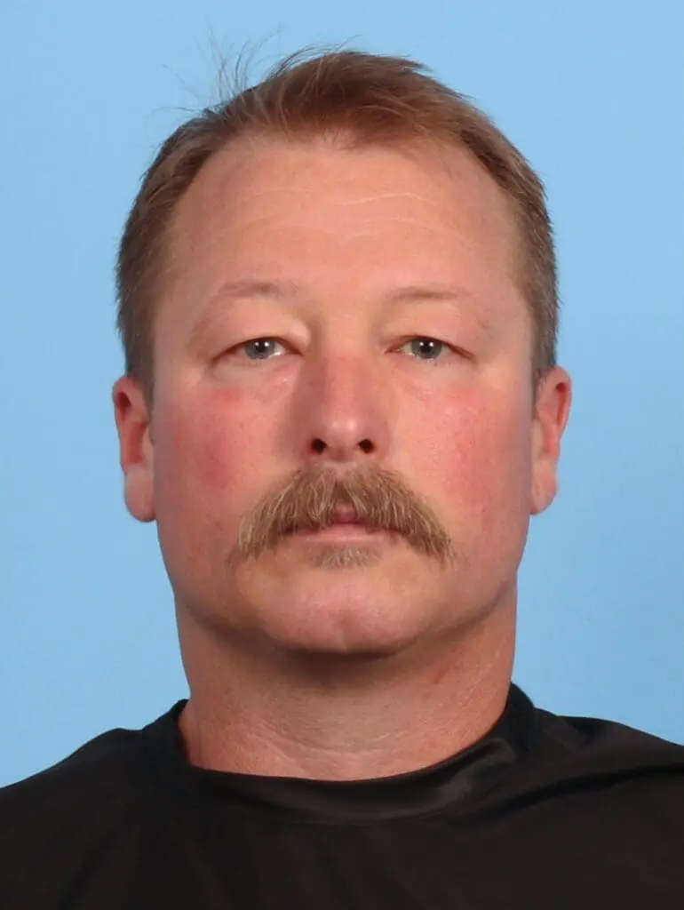 Eyelid Surgery - Case 50892 - Before