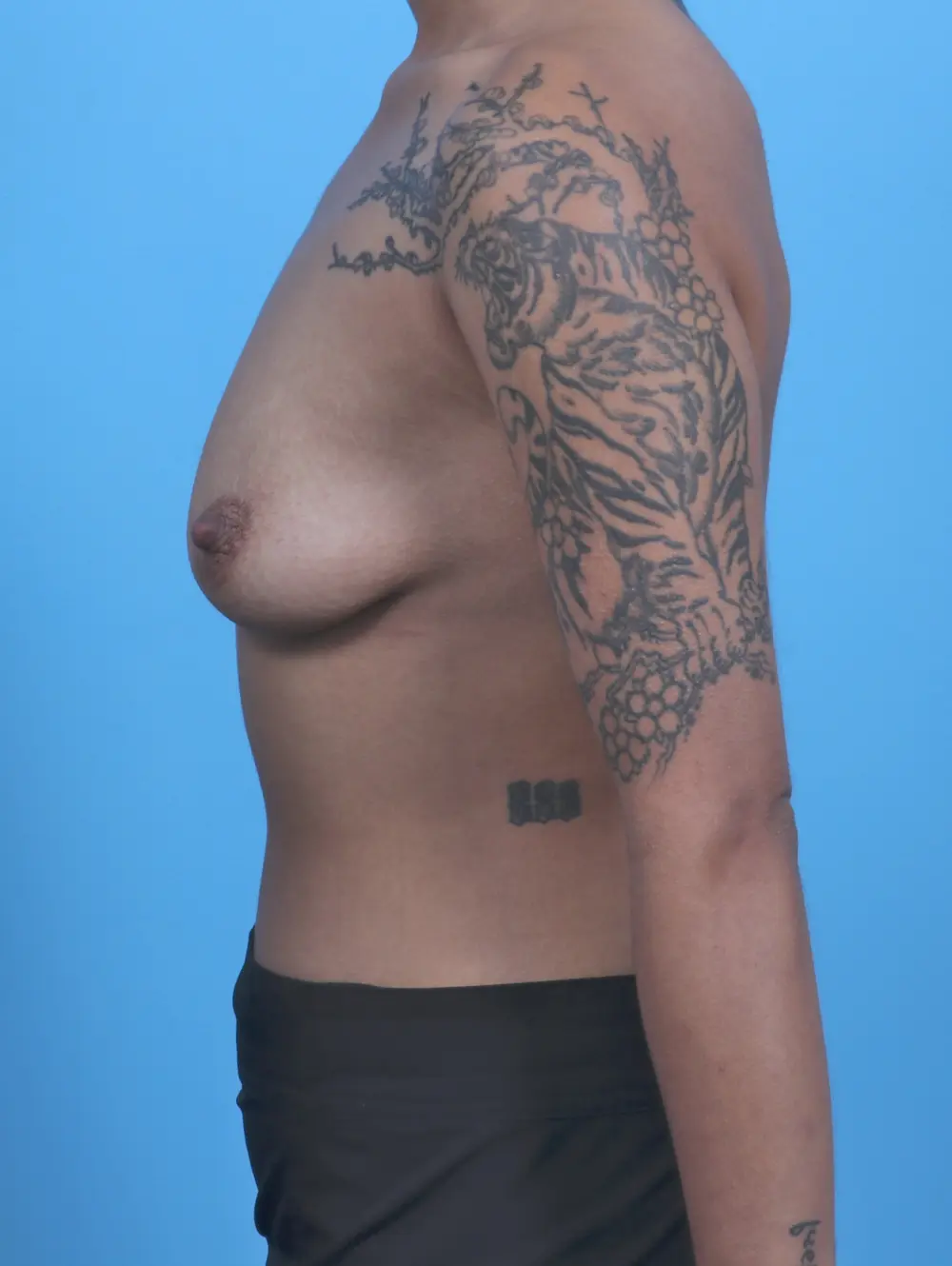 Breast Lift/Reduction with Implants Patient Photo - Case 50900 - before view-2