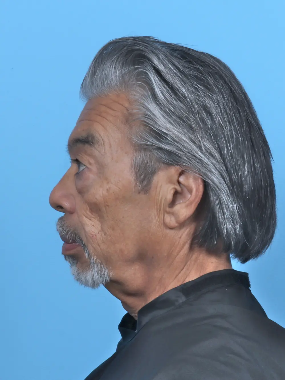 Eyelid Surgery Patient Photo - Case 50908 - before view-2