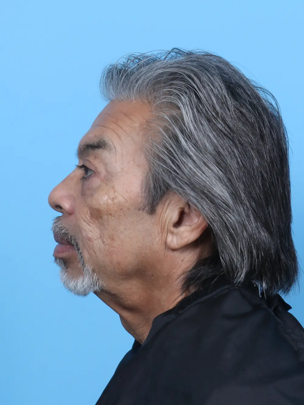 Eyelid Surgery Patient Photo - Case 50908 - after view-2