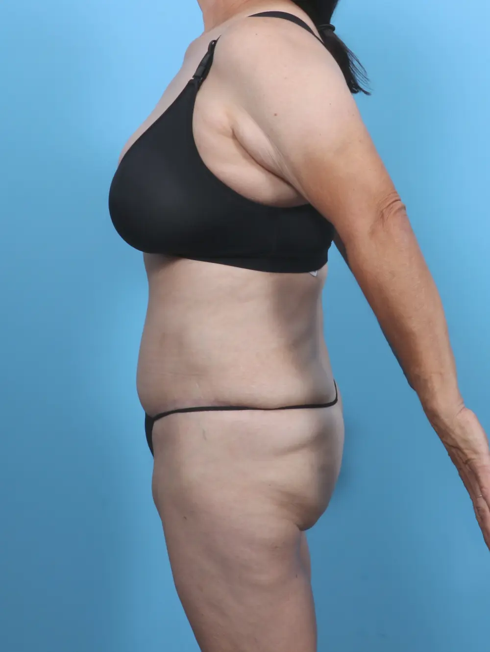 Tummy Tuck Patient Photo - Case 50916 - after view-2
