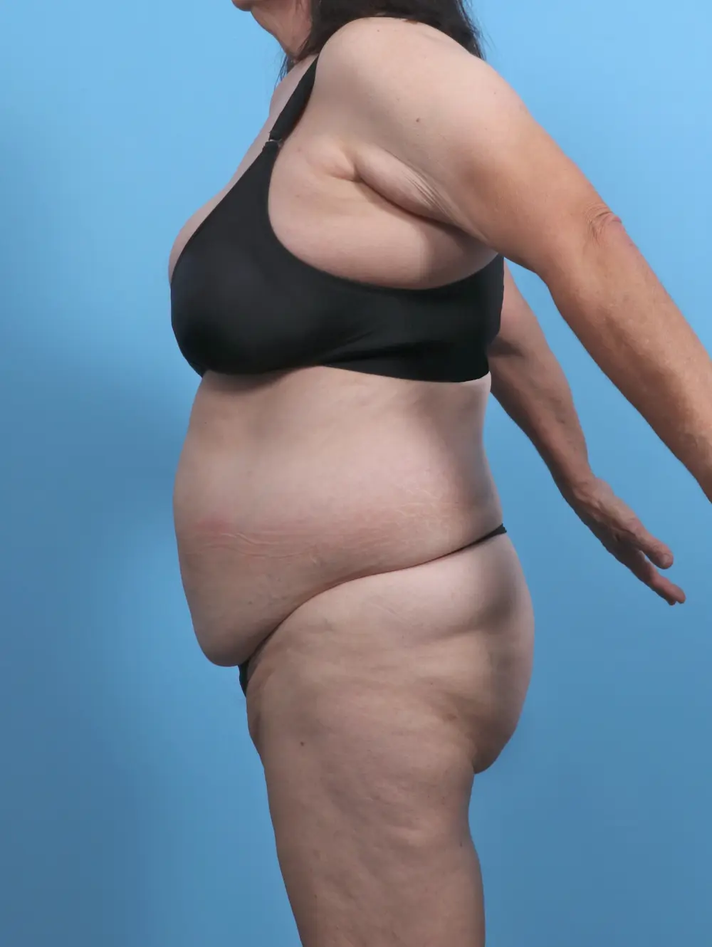 Tummy Tuck Patient Photo - Case 50916 - before view-2