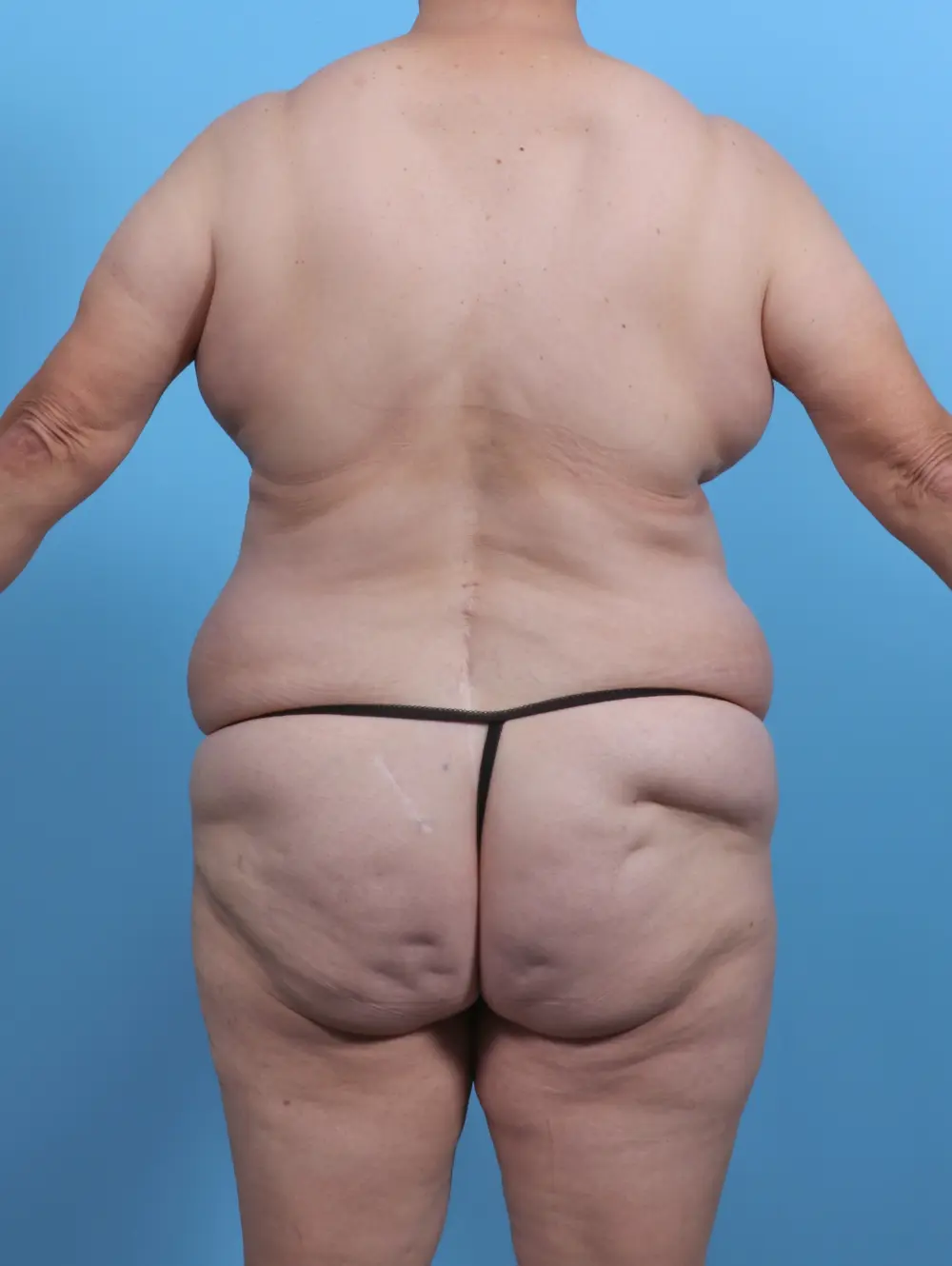 Tummy Tuck Patient Photo - Case 50916 - before view-3