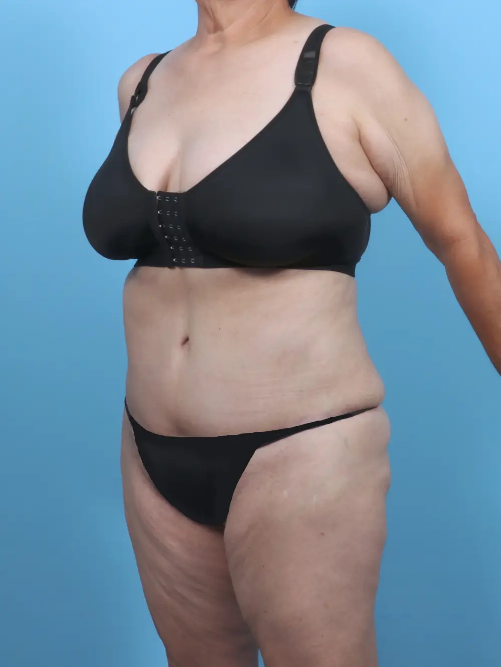Tummy Tuck Patient Photo - Case 50916 - after view-1