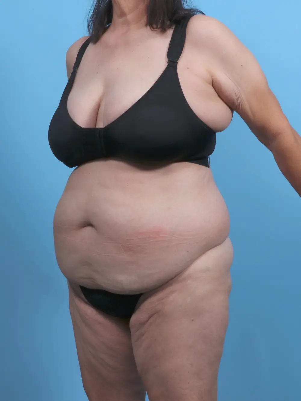 Tummy Tuck Patient Photo - Case 50916 - before view-1