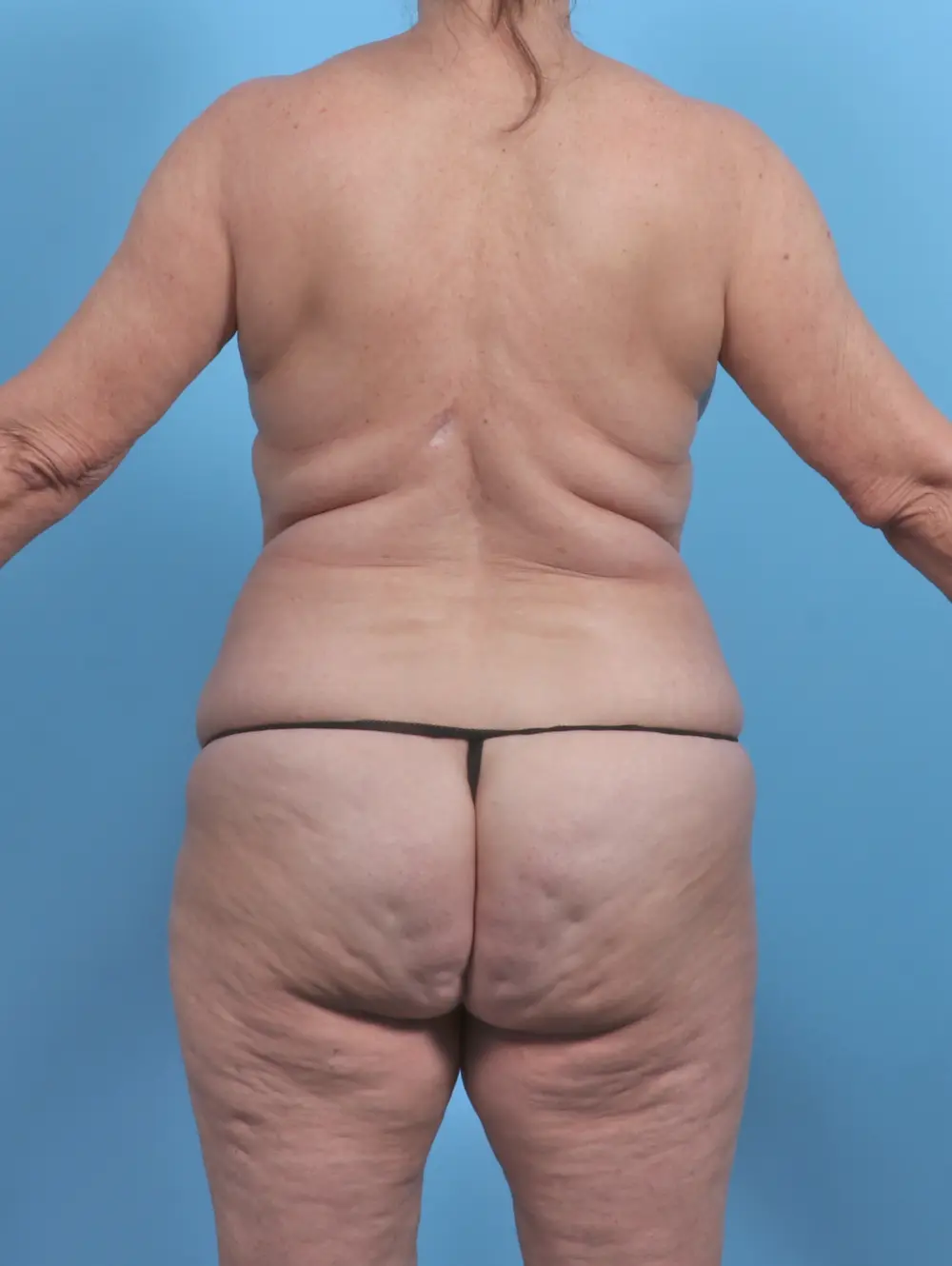 Mommy Makeover Patient Photo - Case 50926 - before view-3