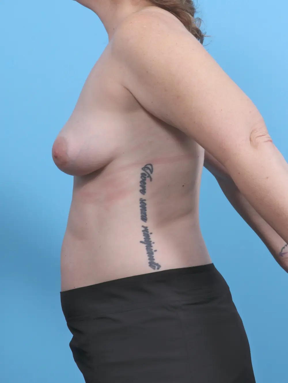 Breast Implant Revision Patient Photo - Case 50942 - before view-2