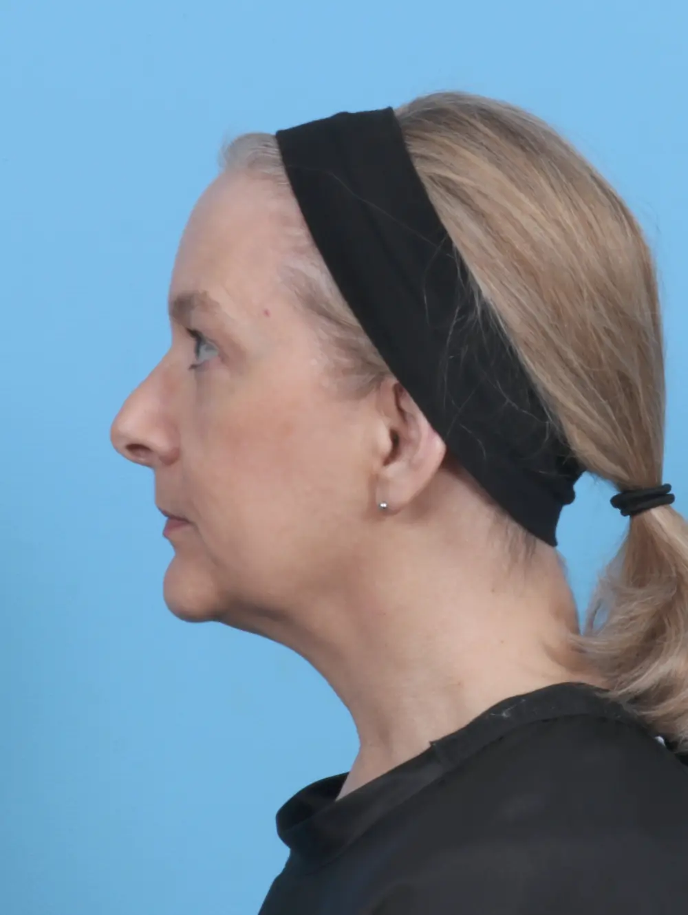 Eyelid Surgery Patient Photo - Case 50950 - before view-2