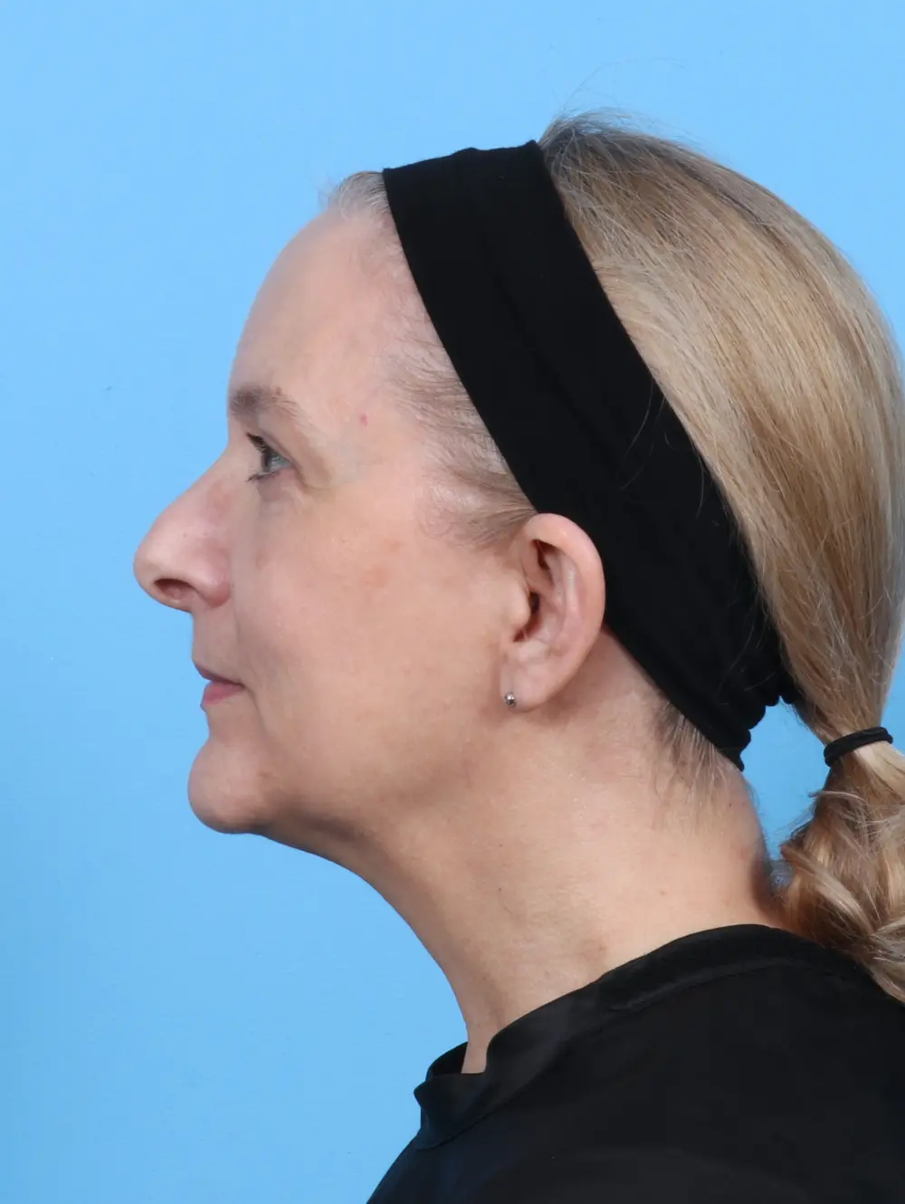 Eyelid Surgery Patient Photo - Case 50950 - after view-2