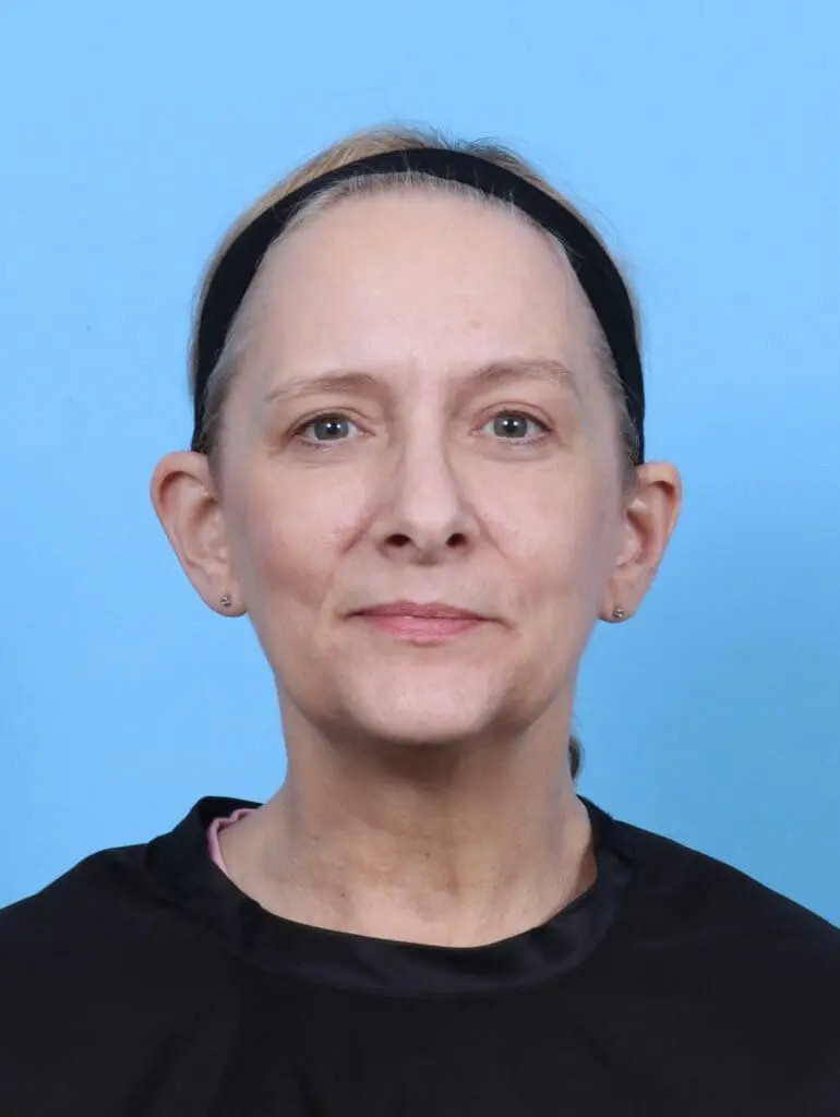 Eyelid Surgery - Case 50950 - After