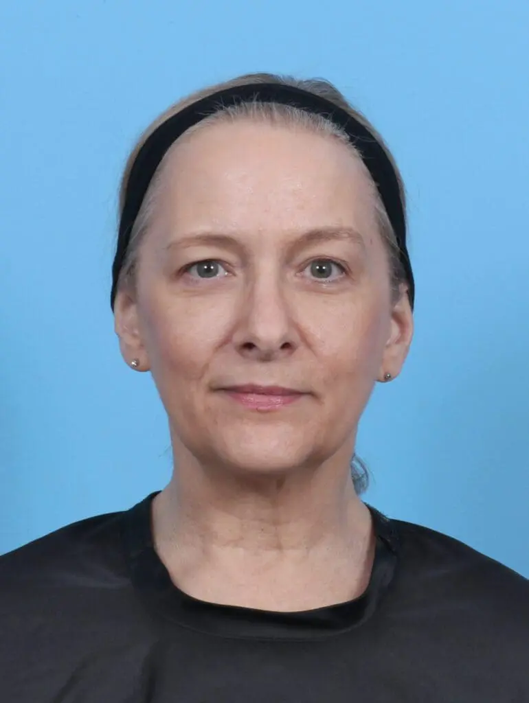 Eyelid Surgery - Case 50950 - Before