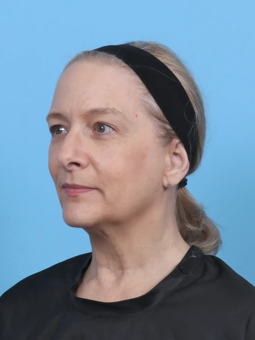 Eyelid Surgery Patient Photo - Case 50950 - before view-1