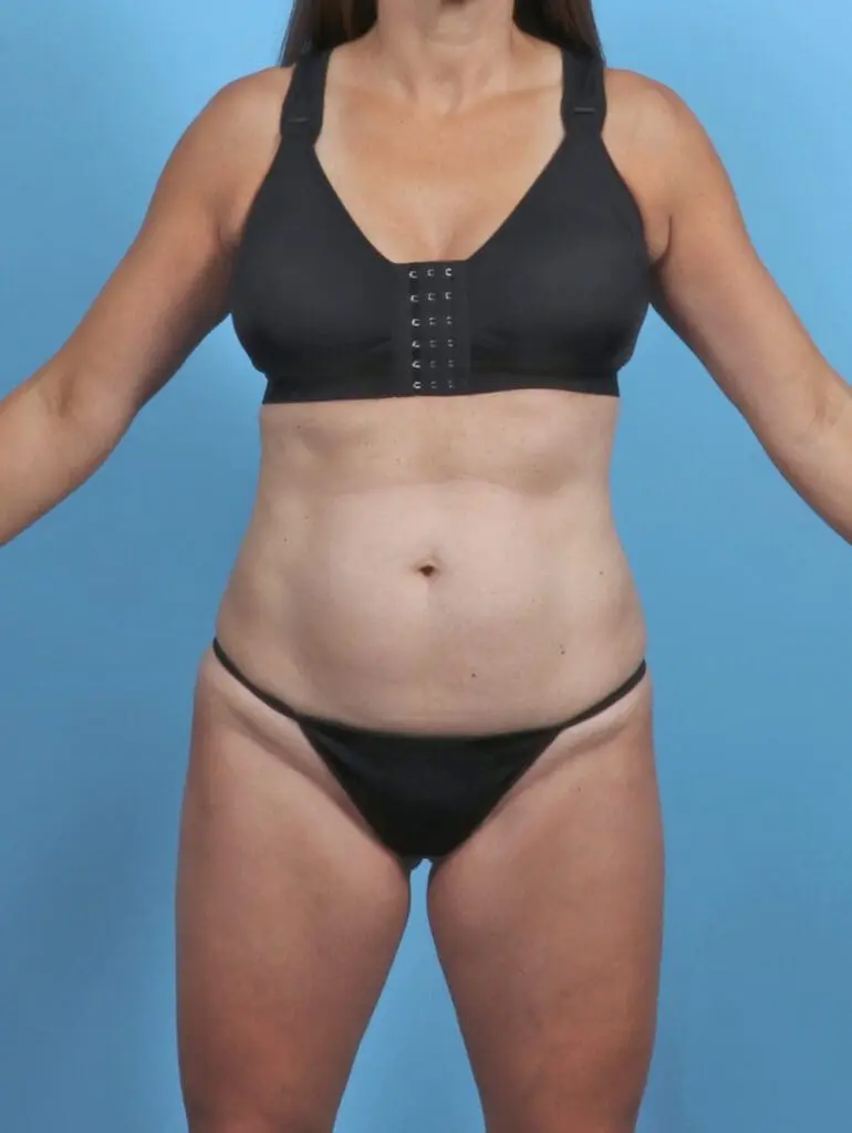 Tummy Tuck - Case 50968 - Before