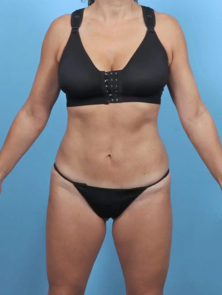 Tummy Tuck - Case 50968 - After