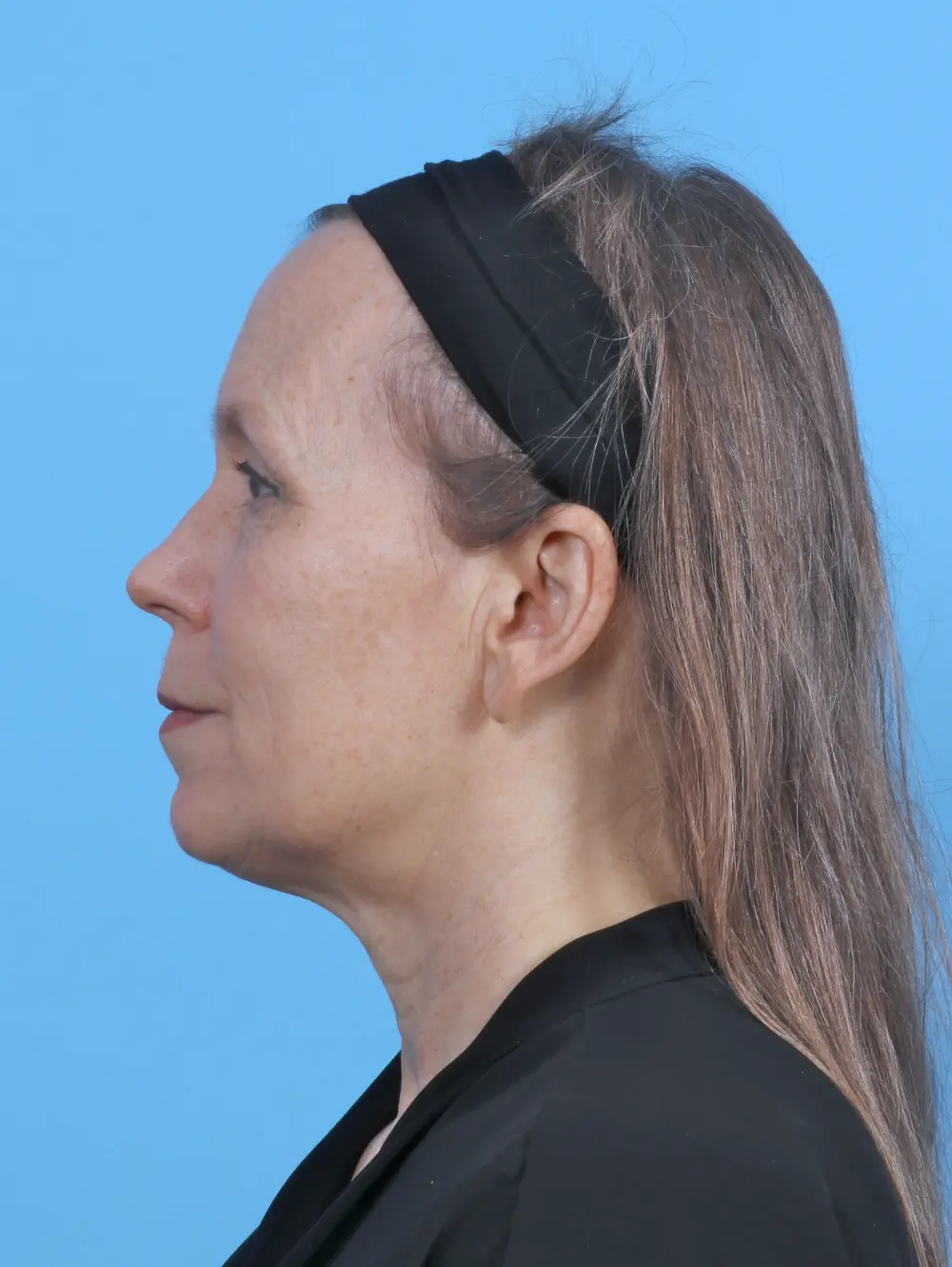 Laser Resurfacing Patient Photo - Case 50984 - before view-2