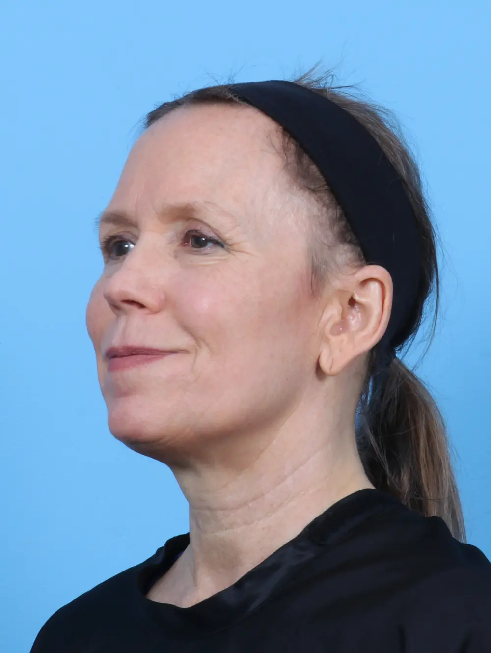 Laser Resurfacing Patient Photo - Case 50984 - after view-1