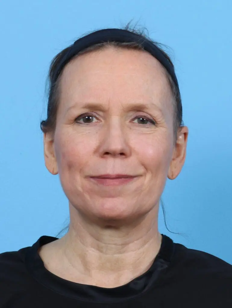 Laser Resurfacing - Case 50984 - After