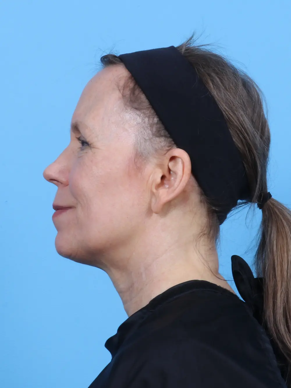 Laser Resurfacing Patient Photo - Case 50984 - after view-2