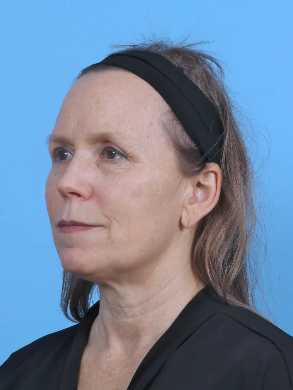 Laser Resurfacing Patient Photo - Case 50984 - before view-1