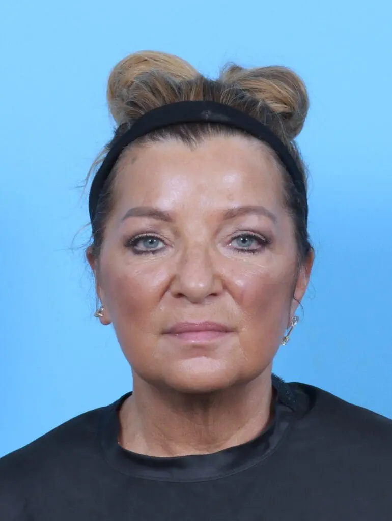 Eyelid Surgery - Case 50993 - After