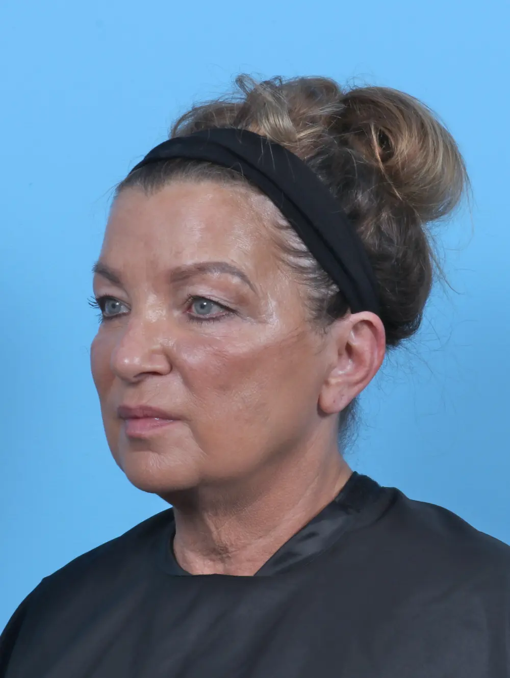 Eyelid Surgery Patient Photo - Case 50993 - before view-1