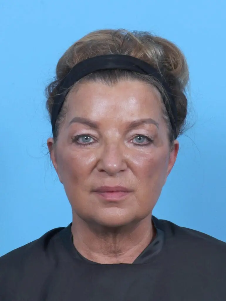 Eyelid Surgery - Case 50993 - Before