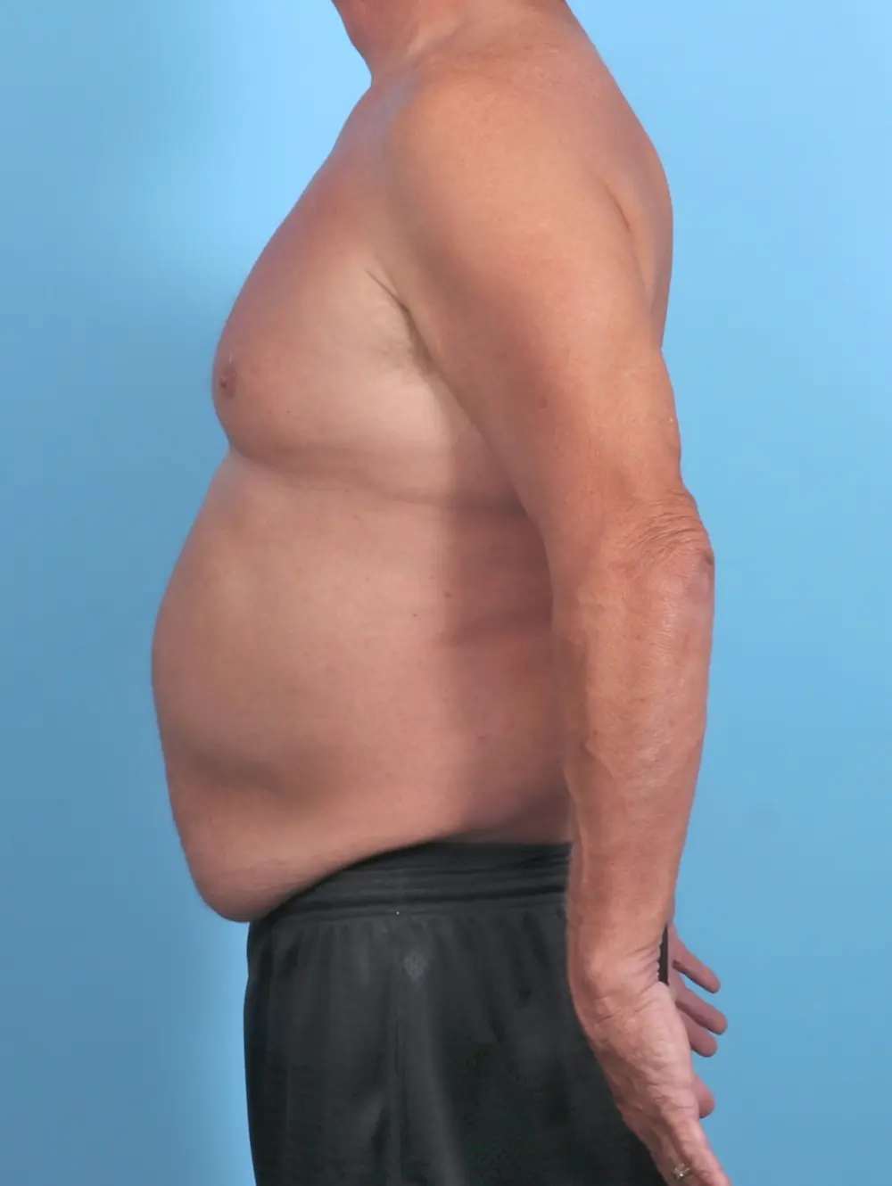 Male Body Lift Patient Photo - Case 51086 - before view-2