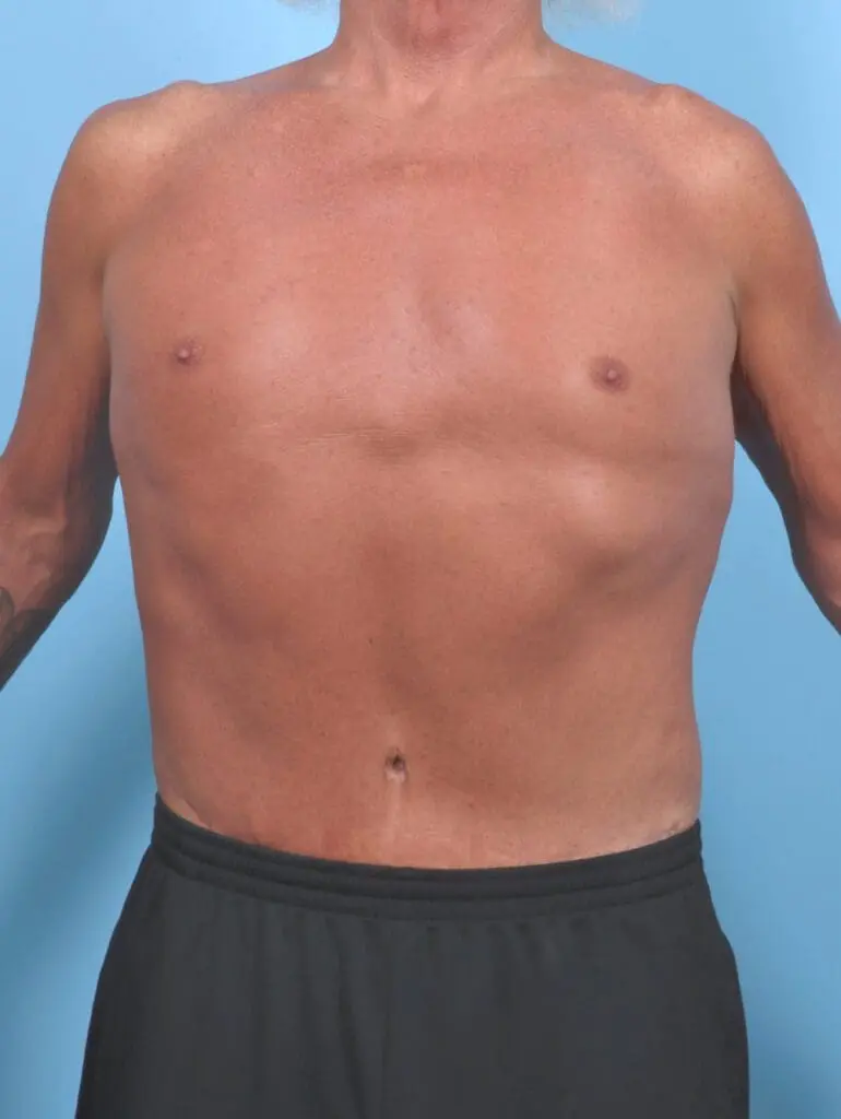 Male Body Lift - Case 51086 - After
