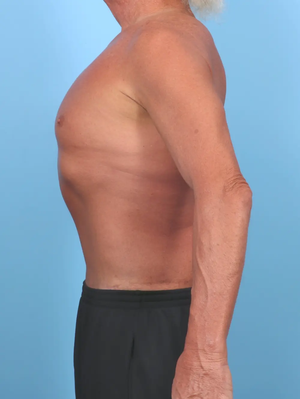 Male Body Lift Patient Photo - Case 51086 - after view-2