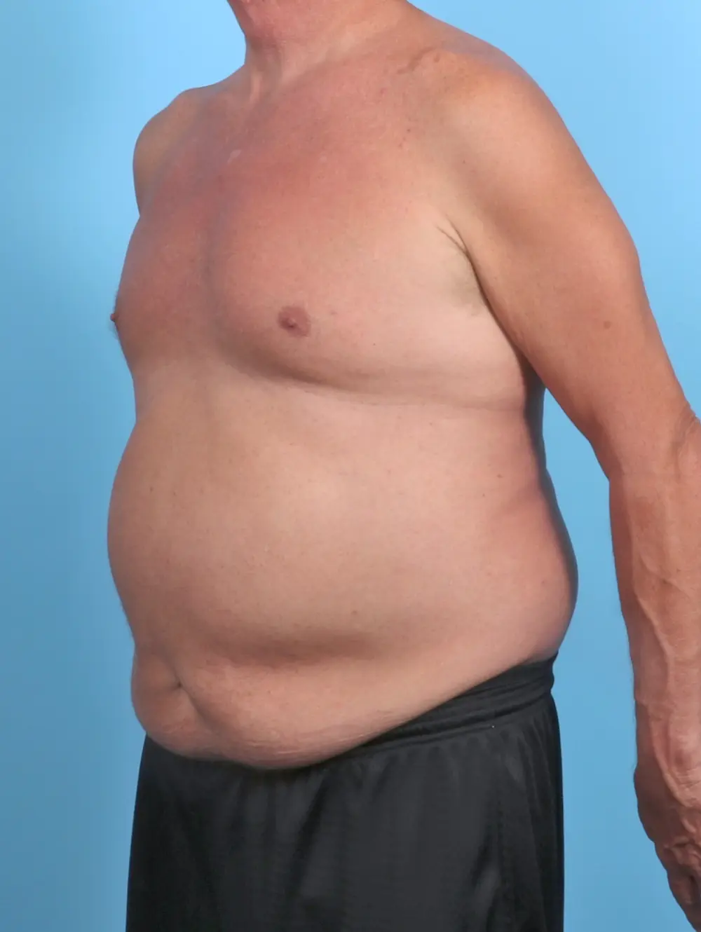 Male Body Lift Patient Photo - Case 51086 - before view-1