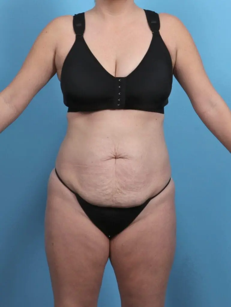 Tummy Tuck - Case 51097 - Before