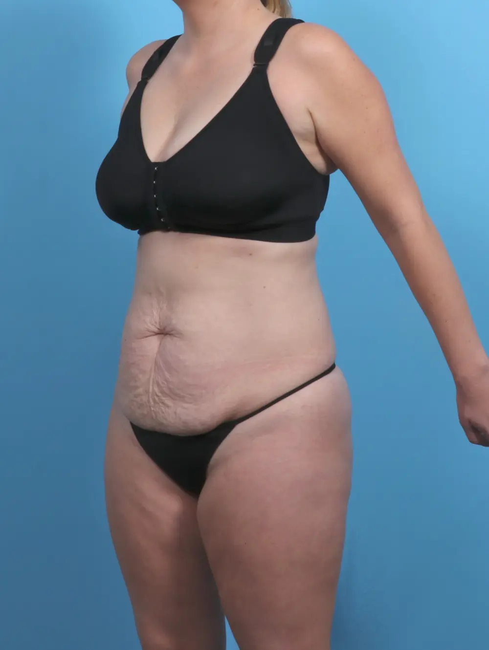 Tummy Tuck Patient Photo - Case 51097 - before view-1