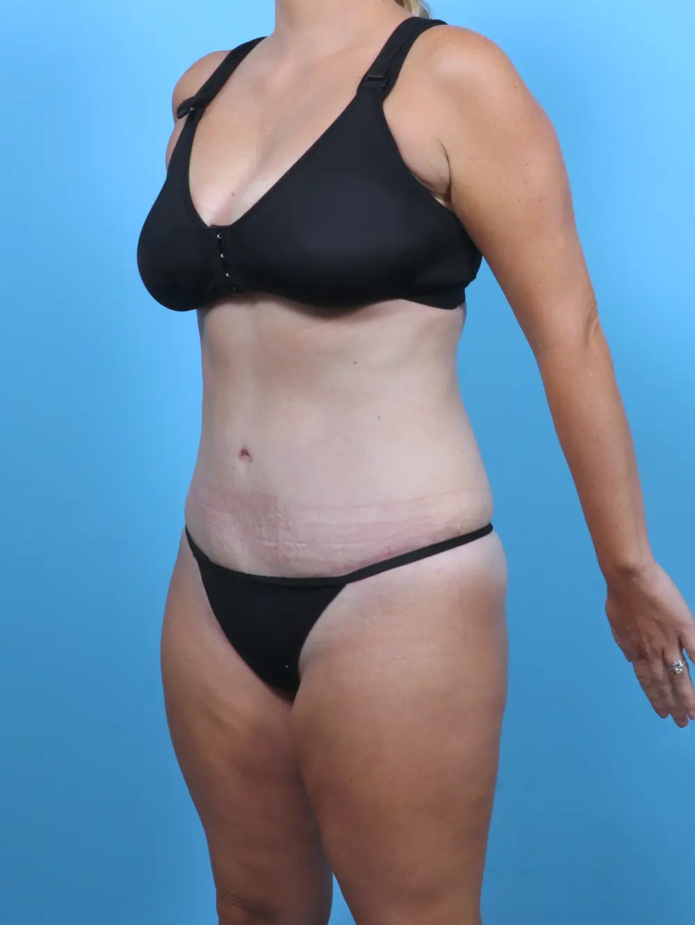 Tummy Tuck Patient Photo - Case 51097 - after view-1