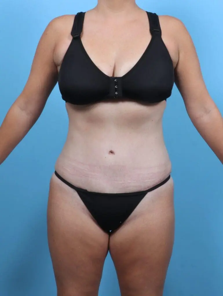 Tummy Tuck - Case 51097 - After