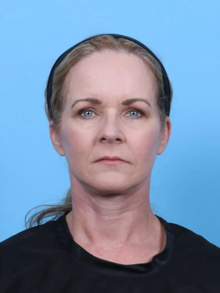 Brow Lift - Case 51105 - After