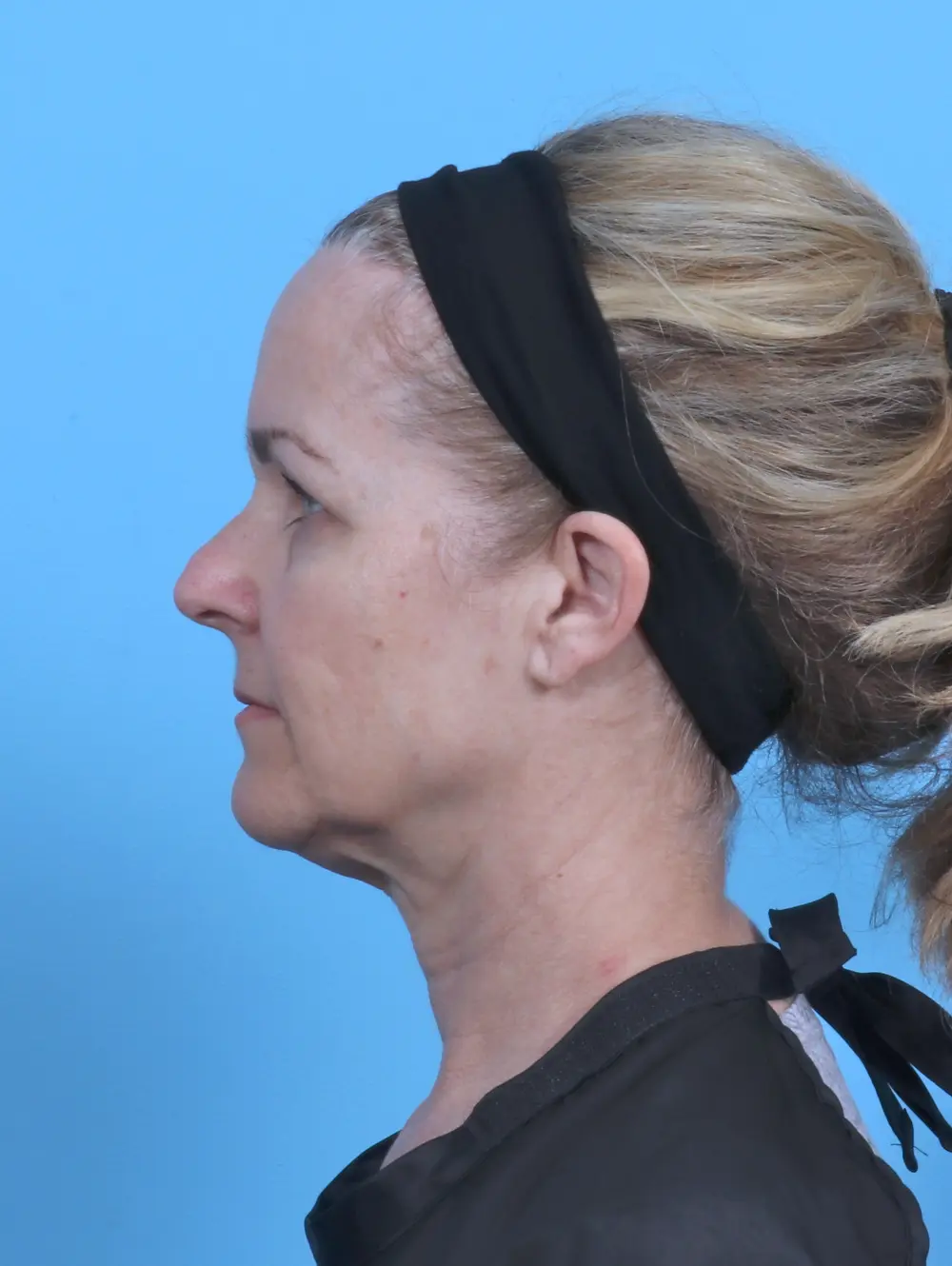 Brow Lift Patient Photo - Case 51105 - before view-2