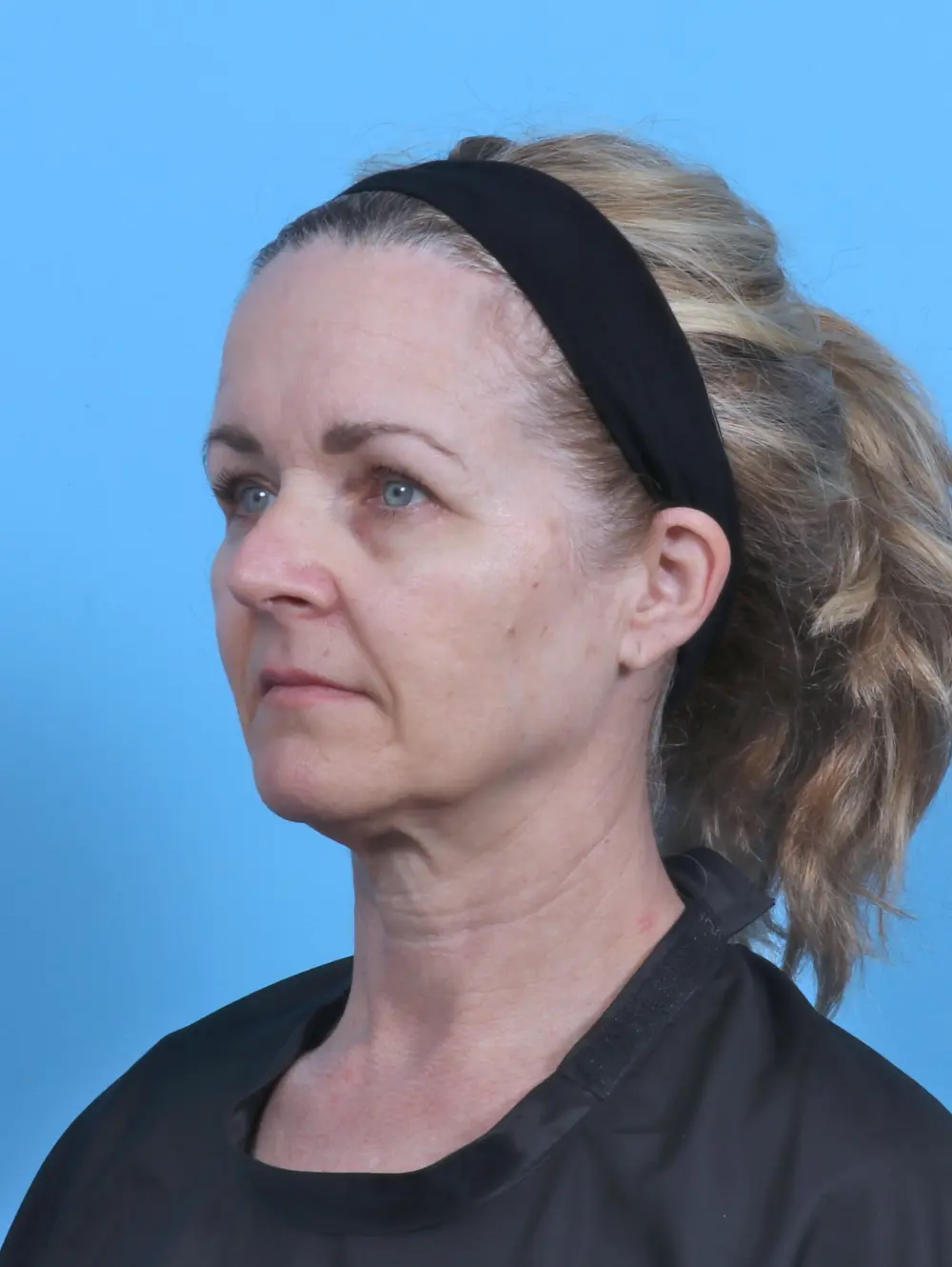 Brow Lift Patient Photo - Case 51105 - before view-1