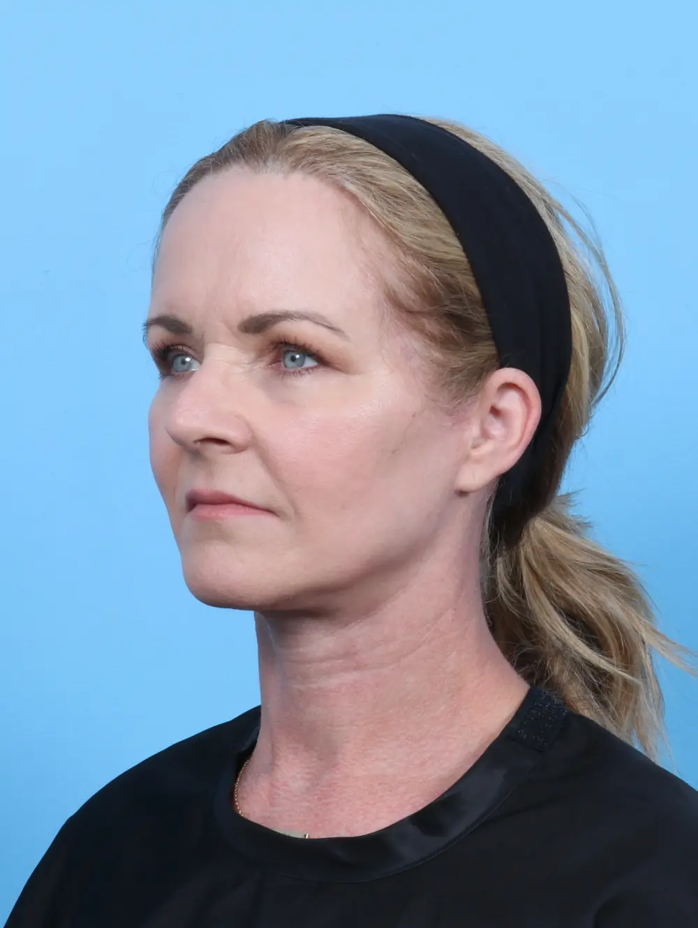 Brow Lift Patient Photo - Case 51105 - after view-1
